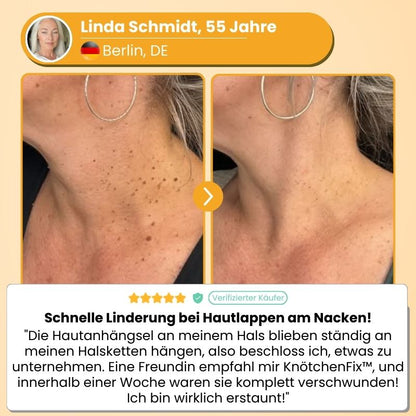 KnötchenFix™ | Hautanhängsel-Entferner Set