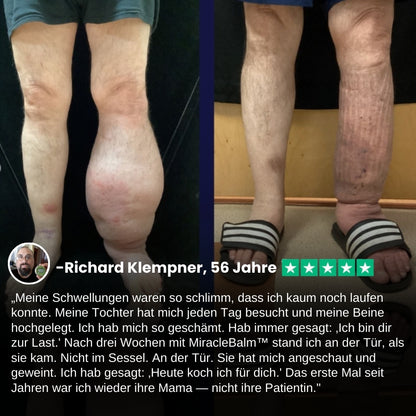 MiracleBalm™ | Beinschwellungen Linderndes Pflege-Balsam