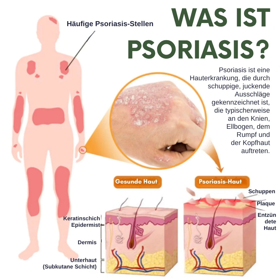 PsoriaCalm™ | Ekzem- und Psoriasis-Creme