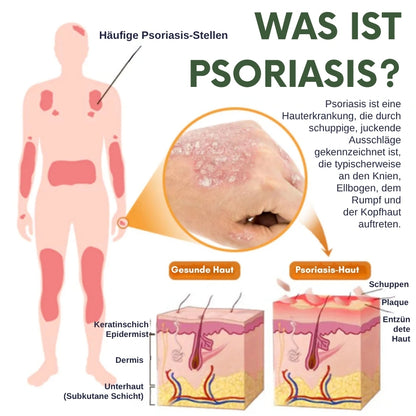 PsoriaCalm™ | Ekzem- und Psoriasis-Creme