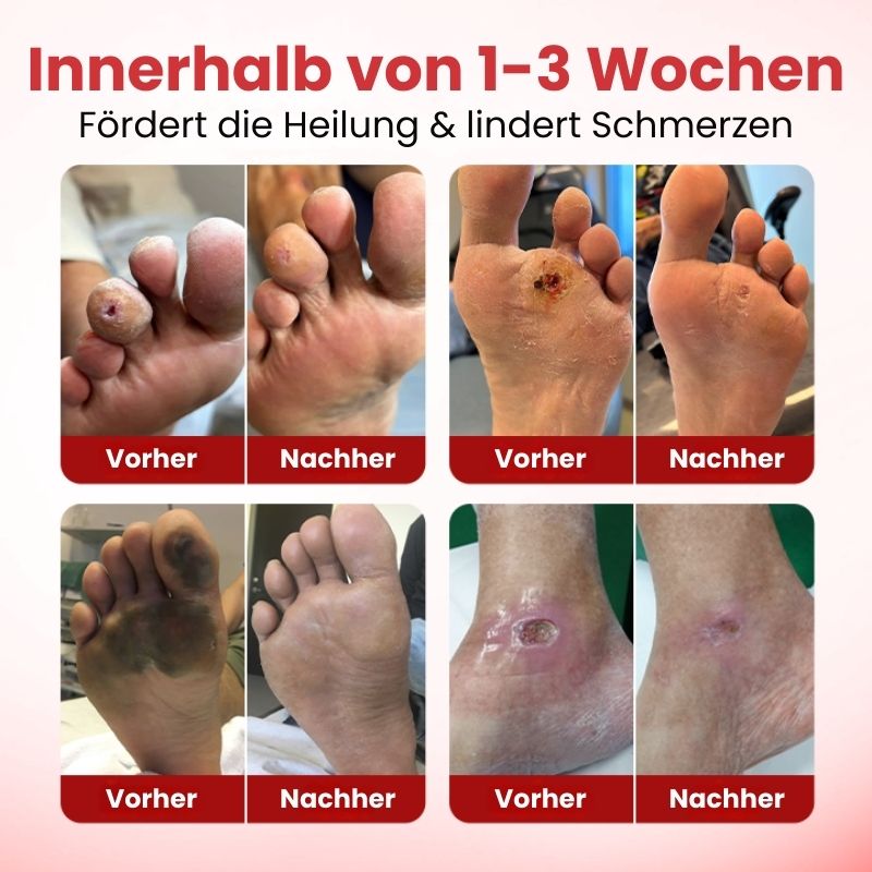 VitaGluco™ | Diabetische Hautreparaturcreme