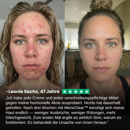 MenoClear™ | Akne-Gummis für die Menopause