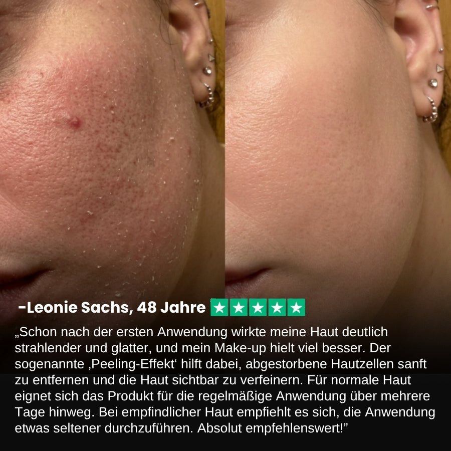 PeelShot™ | Fortschrittliches Poren-reinigendes Exfoliationssystem