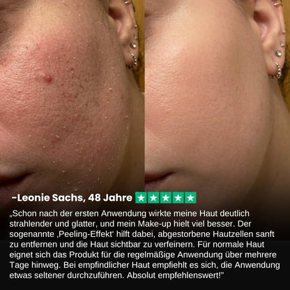 PeelShot™ | Fortschrittliches Poren-reinigendes Exfoliationssystem