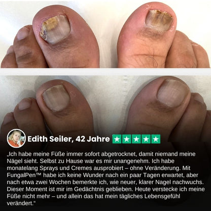 FungalPen™ | Nagelpflege Anti-Pilz-Stift