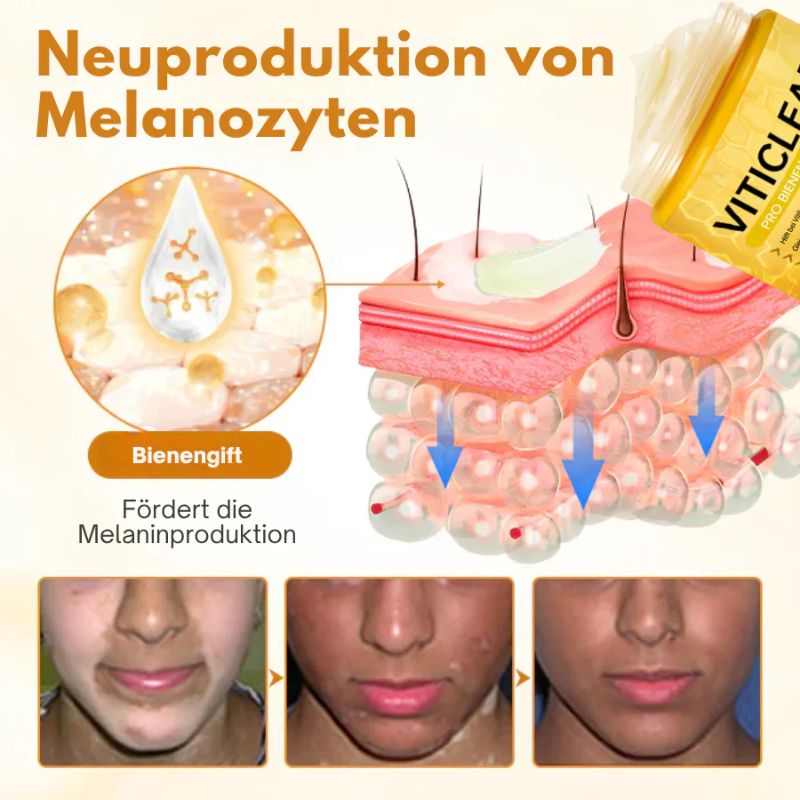 VitiClear™ | Bienengift Vitiligo Creme