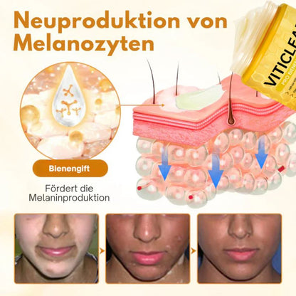 VitiClear™ | Bienengift Vitiligo Creme