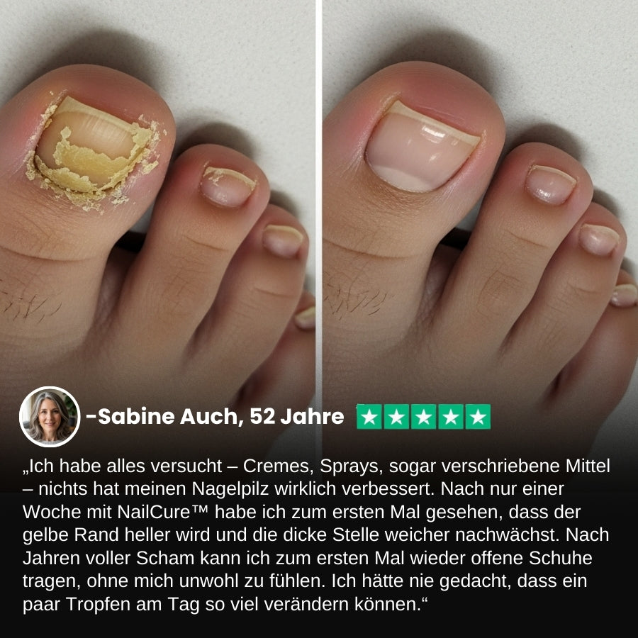 NailCure™ | Fungi Nail Triple Action Formel