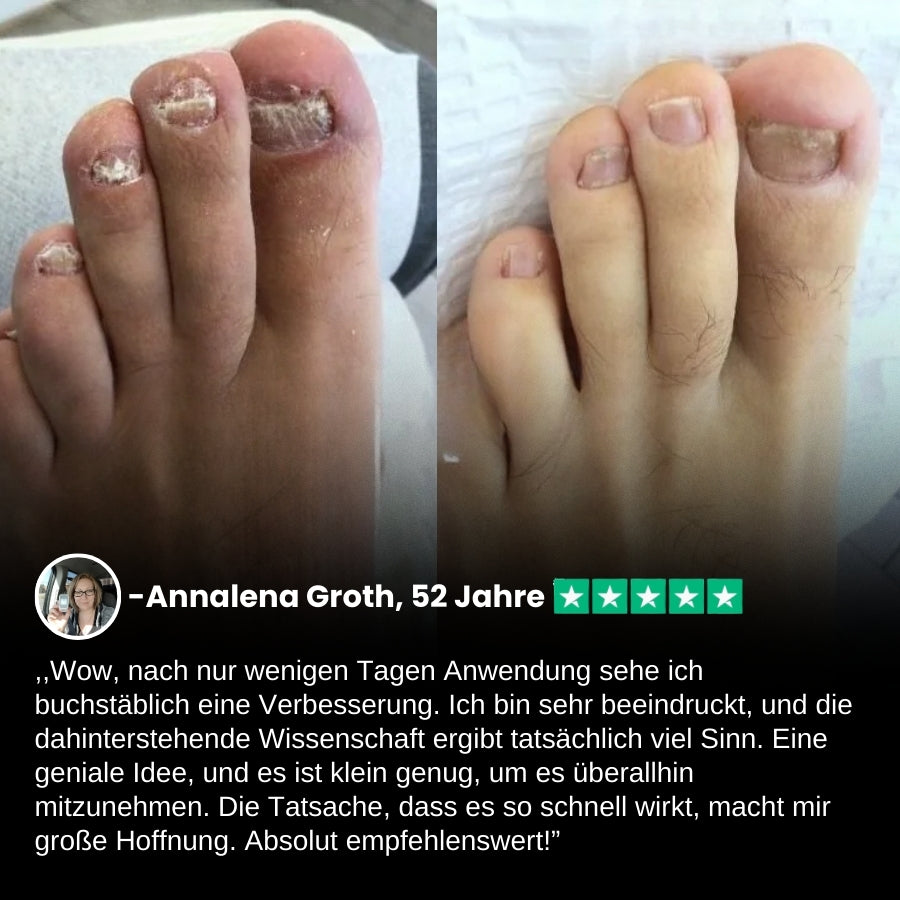 ClearNail Pro™ | Nagelpilz-Lasergerät