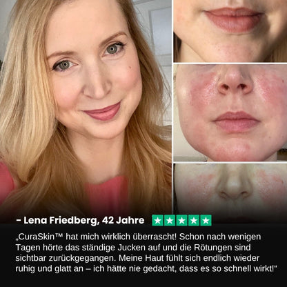 CuraSkin™ | Psoriasis- und Ekzem-Creme