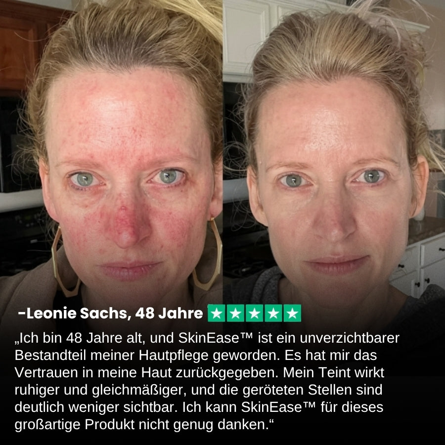 SkinEase™ | Beruhigendes Serum für reaktive, zu Rötungen neigende Haut