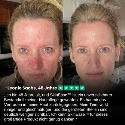 SkinEase™ | Beruhigendes Serum für reaktive, zu Rötungen neigende Haut