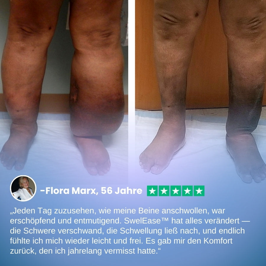SwelEase™ | Kräutercreme zur Ödempflege