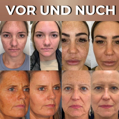 GlowPeel™ | Peeling-Gesichtsmaske