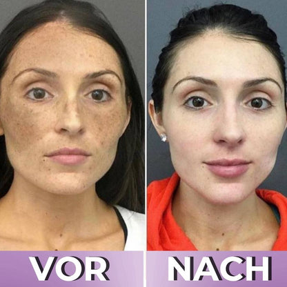 BrillaSkin™ | Fortschrittliche Anti-Hyperpigmentierungscreme