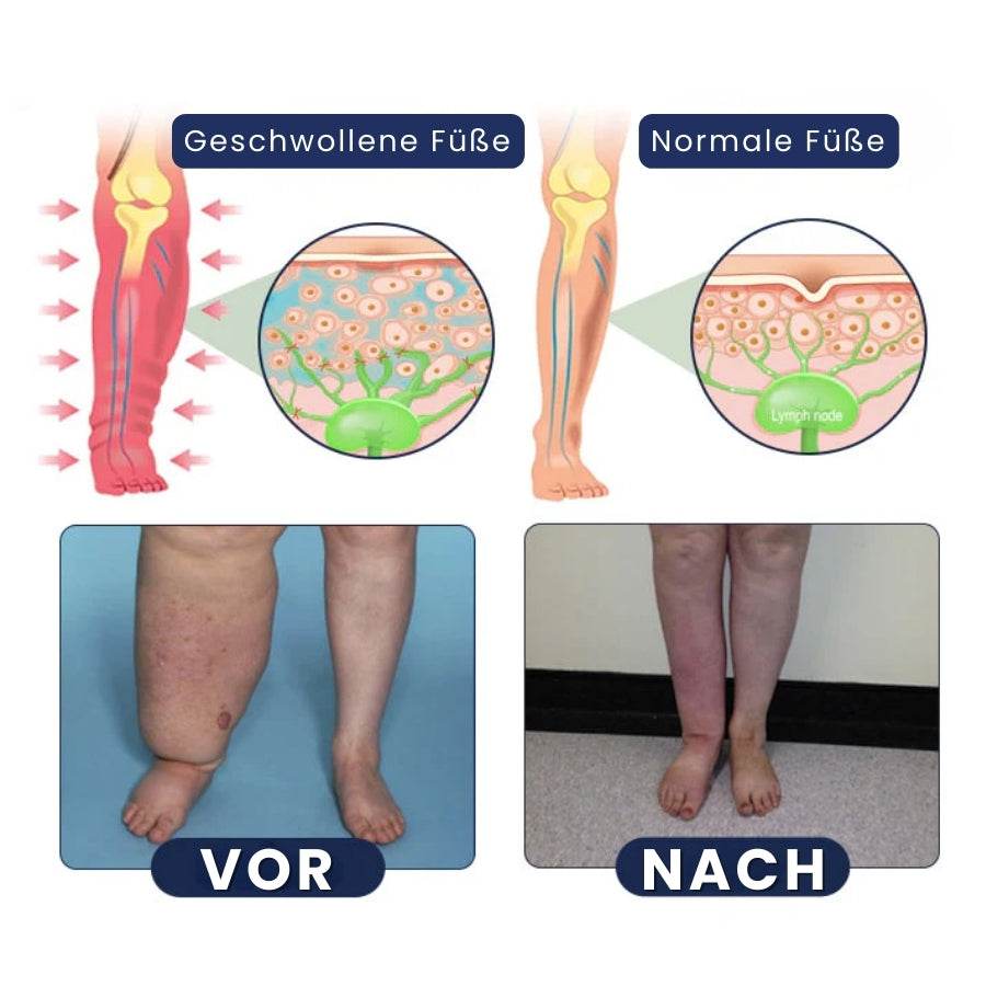 SwelRelief™ | Creme zur Linderung von Beinödemen
