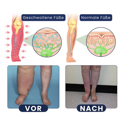 SwelRelief™ | Creme zur Linderung von Beinödemen