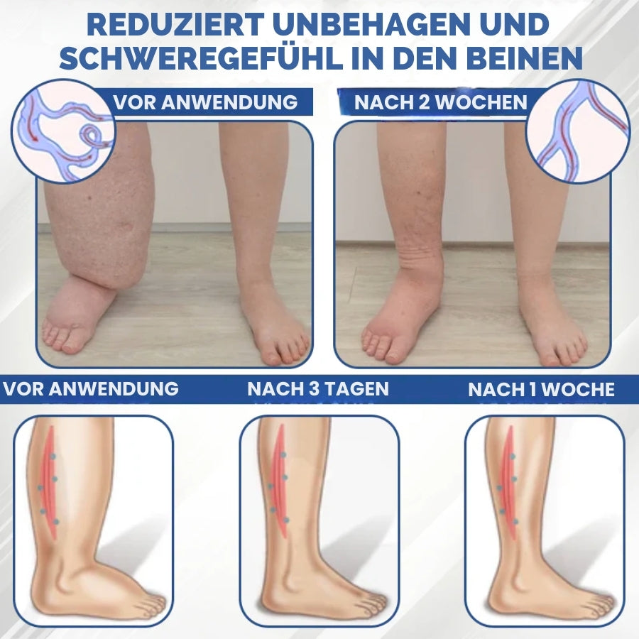 SwelEase™ | Kräutercreme zur Ödempflege