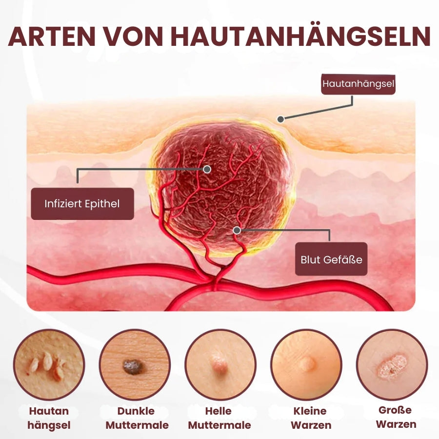 KeraErase™ | Pflanzliche Warzenentfernungscreme mit Doppelwirkung