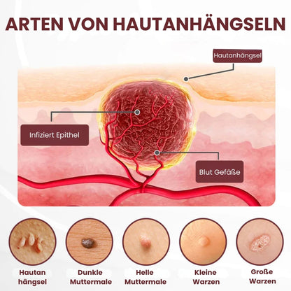 KeraErase™ | Pflanzliche Warzenentfernungscreme mit Doppelwirkung