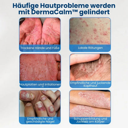 DermaCalm™ | Natürliche Linderung bei juckender Kopfhaut oder Haut