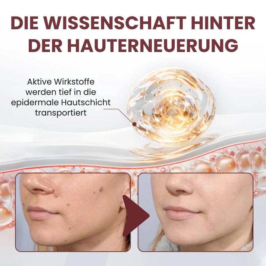 KeraErase™ | Pflanzliche Warzenentfernungscreme mit Doppelwirkung