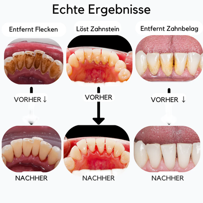 SmiSonic™ | Zahnreiniger