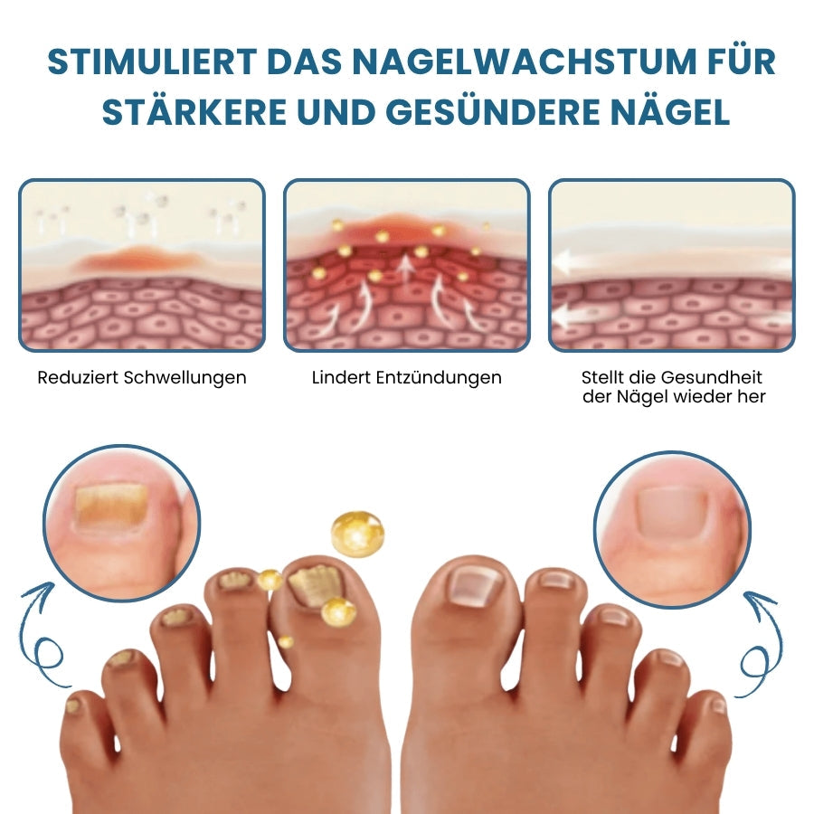 Nailixir™ | Nagelpilzbehandlungssalbe
