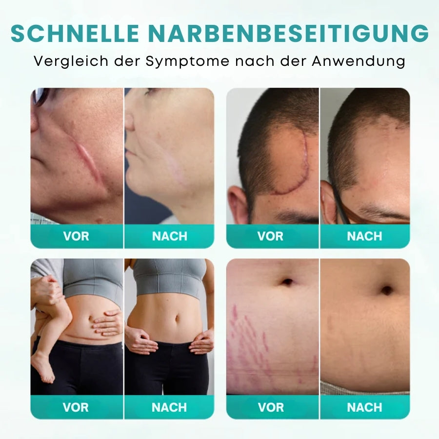 ScarSolve™ | Medizinisches Narbenspray