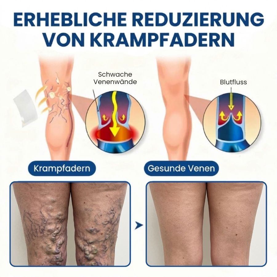 Varinyx™ | Microneedling-Pflaster gegen Krampfadern