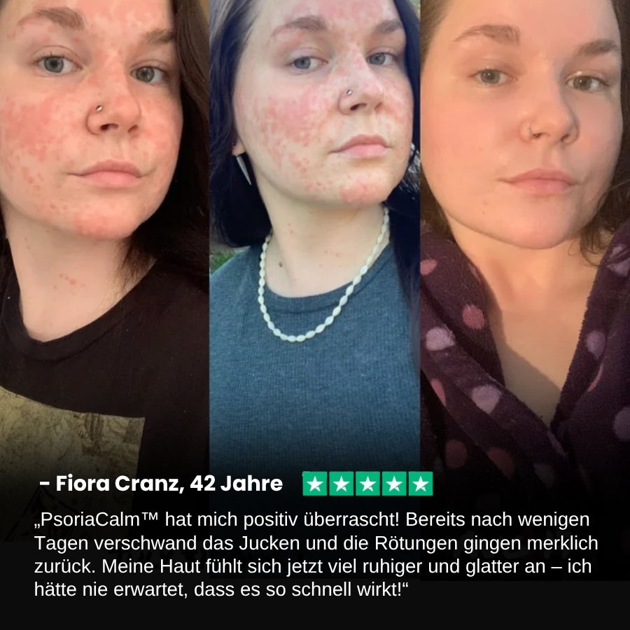PsoriaCalm™ | Ekzem- und Psoriasis-Creme
