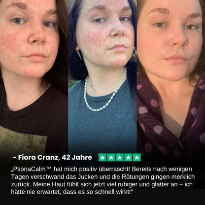 PsoriaCalm™ | Ekzem- und Psoriasis-Creme