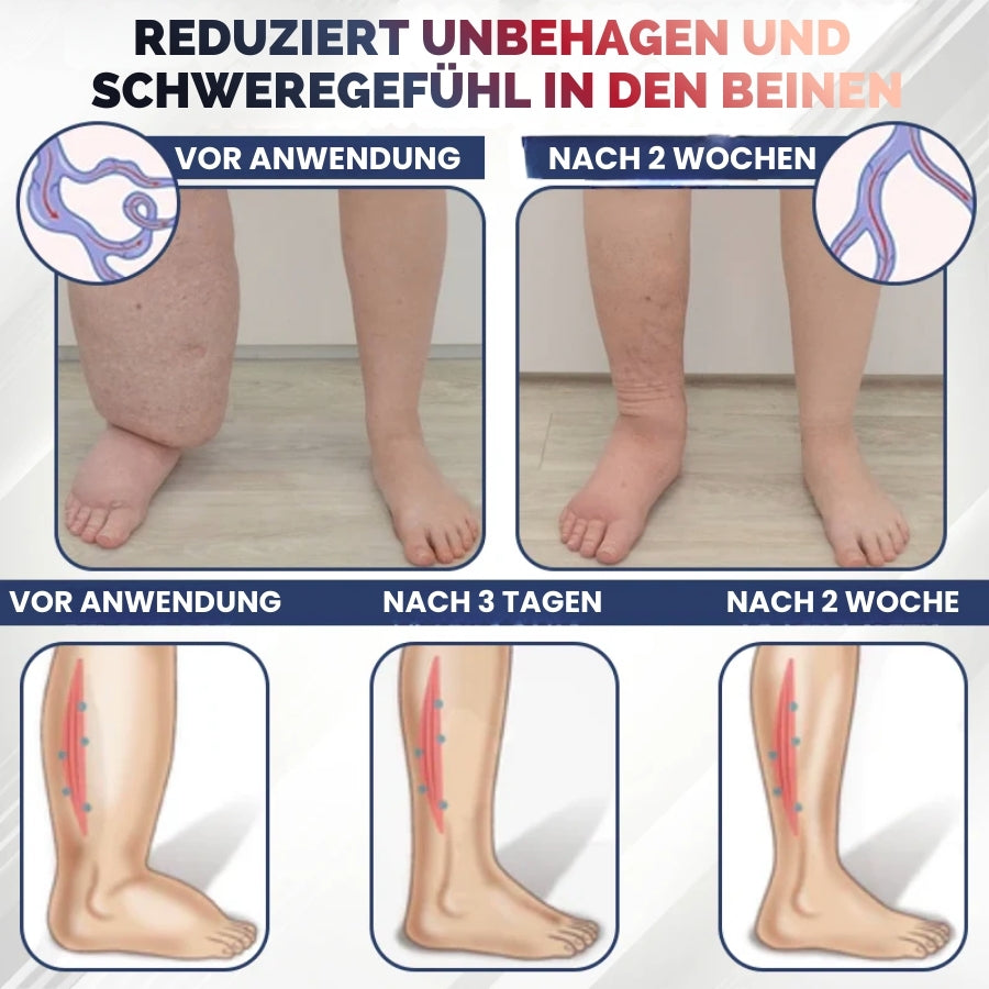 SwelRelief™ | Creme zur Linderung von Beinödemen