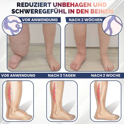 SwelRelief™ | Creme zur Linderung von Beinödemen