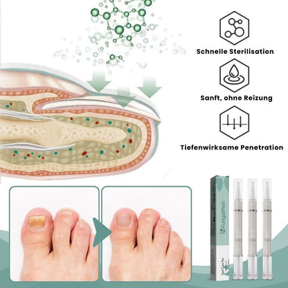 FungalPen™ | Nagelpflege Anti-Pilz-Stift