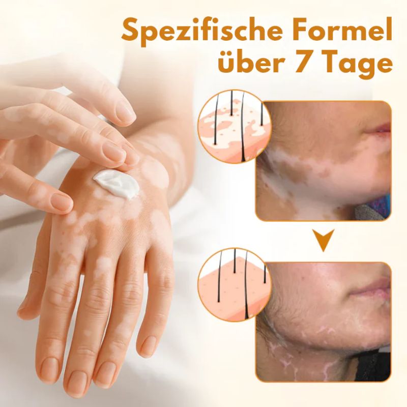 VitiClear™ | Bienengift Vitiligo Creme