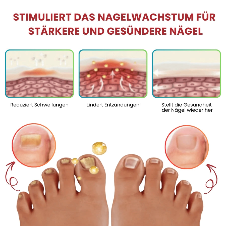 NailCure™ | Fungi Nail Triple Action Formel