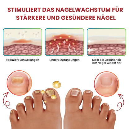 NailCure™ | Fungi Nail Triple Action Formel