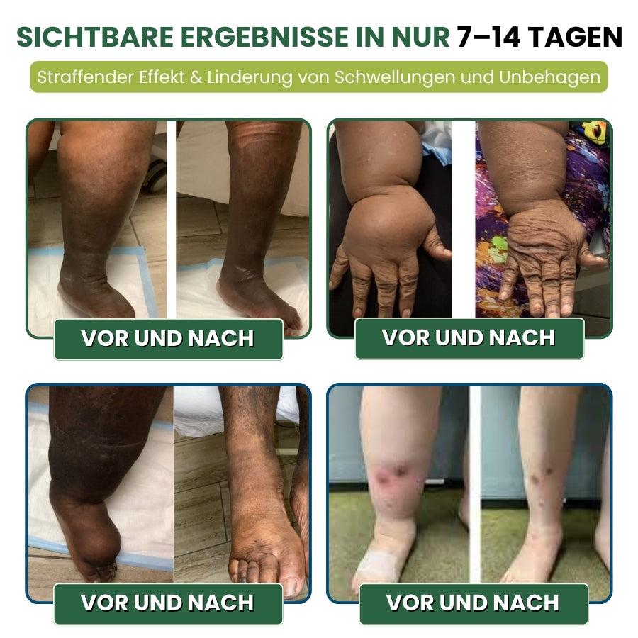 MiracleBalm™ | Beinschwellungen Linderndes Pflege-Balsam