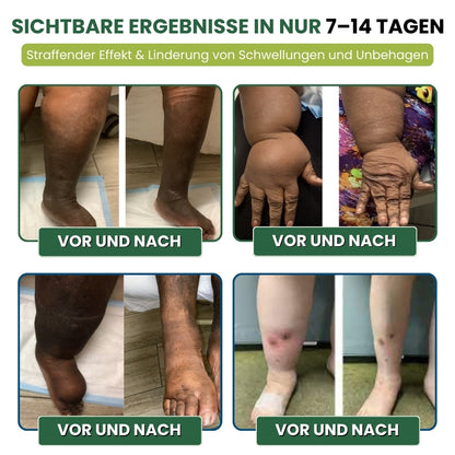 MiracleBalm™ | Beinschwellungen Linderndes Pflege-Balsam