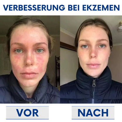 CuraSkin™ | Psoriasis- und Ekzem-Creme