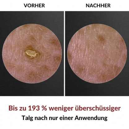 PeelShot™ | Fortschrittliches Poren-reinigendes Exfoliationssystem