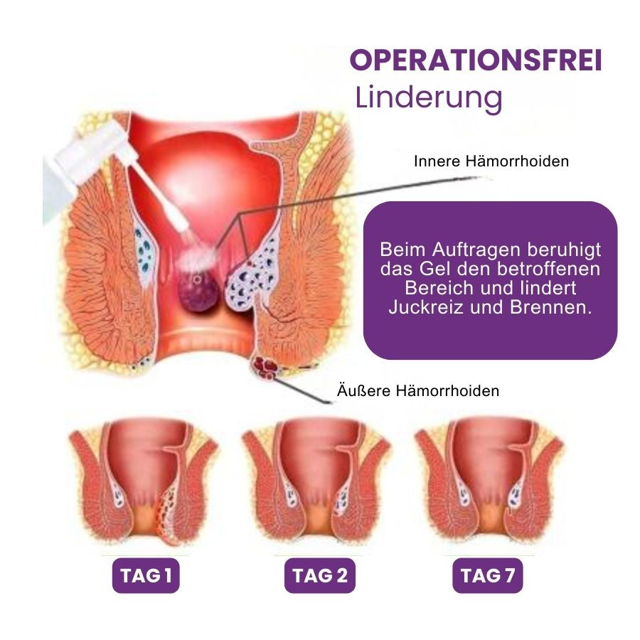 HemoCure™ | Hämorrhoiden Erfrischendes Beruhigendes Gel