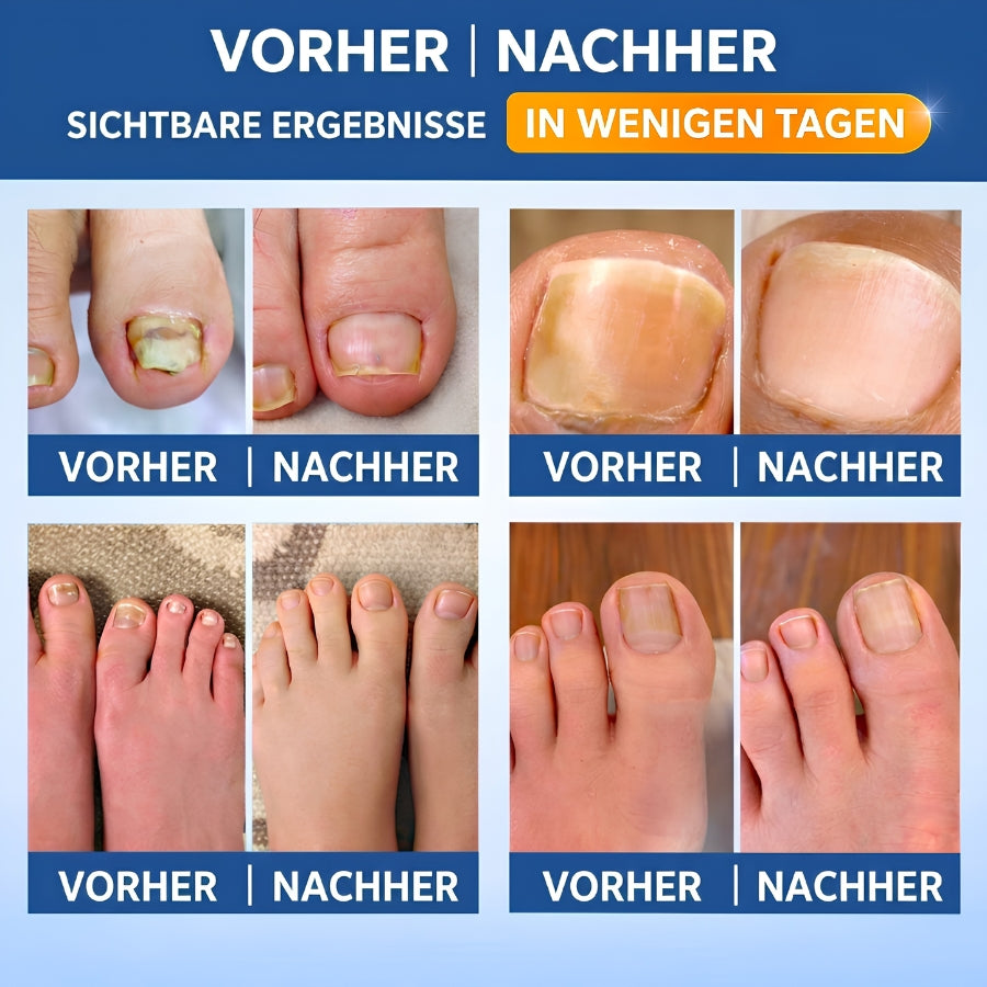 NailRepair™ | Antimykotisches Nagelpflaster