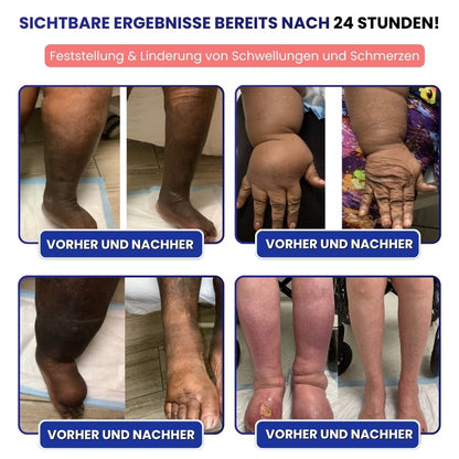 VitaLegs™ | Anti-Ödem-Creme