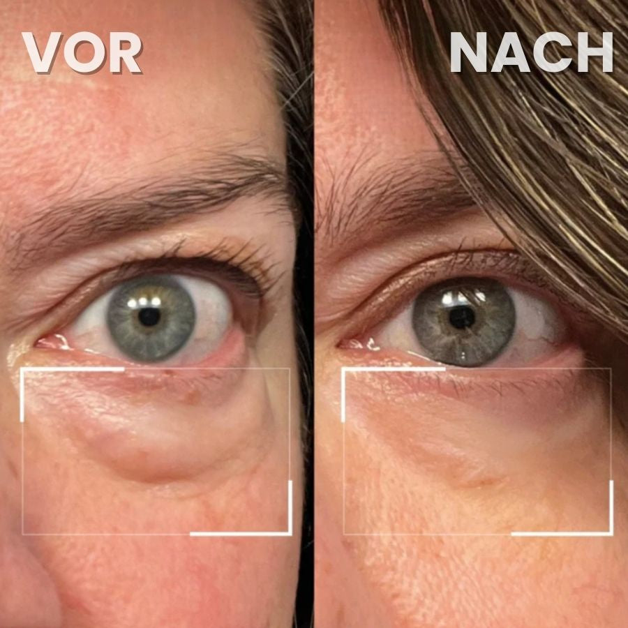 LidLift™ | Augenlid-Straffungscreme