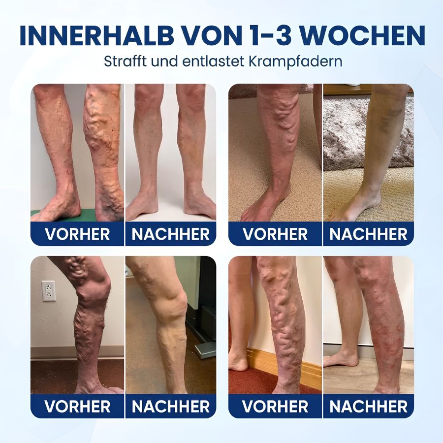 Varinyx™ | Microneedling-Pflaster gegen Krampfadern