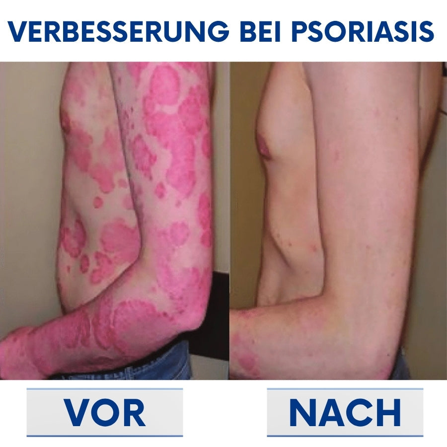 CuraSkin™ | Psoriasis- und Ekzem-Creme