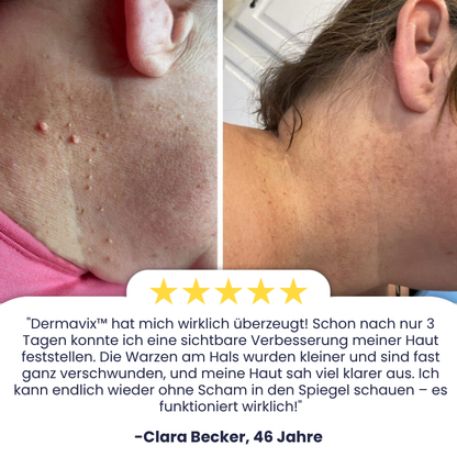 Dermavix™ | Entfernt 97% der Warzen & Hauttaggen in nur 3 Tagen!