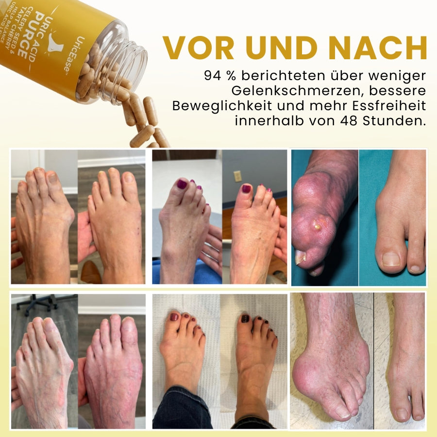 UricEase™ | Formel zum Schutz vor Harnsäure